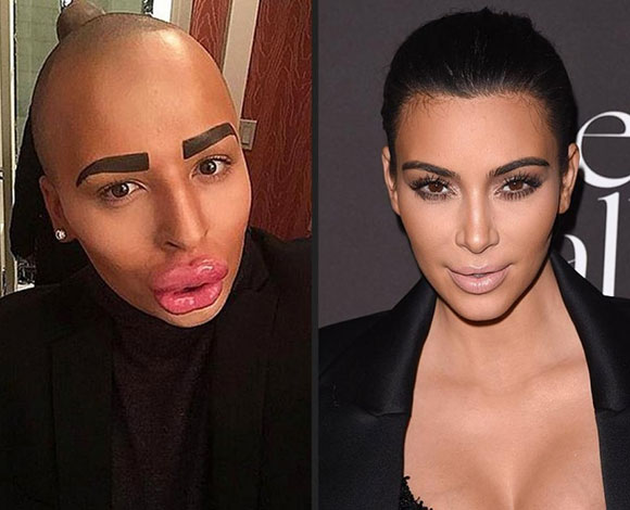 اشهر حالات عمليات التجميل الفاشلة للتشبه بالنجوم والنجمات