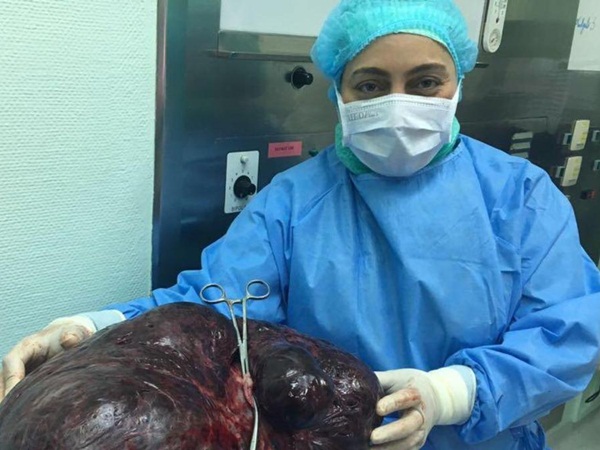 دبي .. استئصال ورم عملاق في عملية نادرة