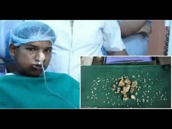 حالة نادرة لفتى لديه 232 سنًا داخل فمه