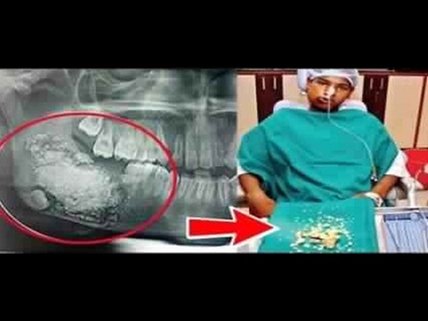 حالة نادرة لفتى لديه 232 سنًا داخل فمه