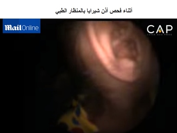 شاهد عش من النمل يحتل أذن طفلة هندية