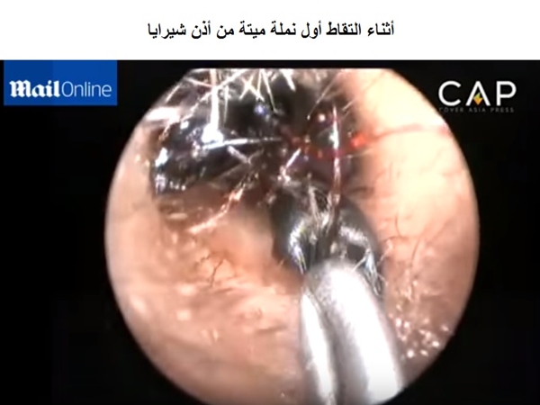 شاهد عش من النمل يحتل أذن طفلة هندية