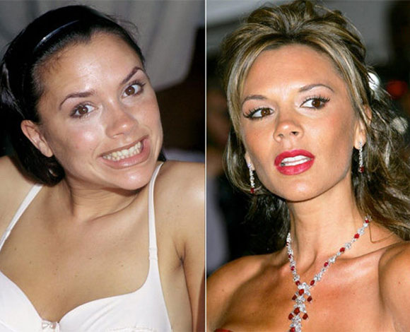 أبزر النجوم الذين خضعوا لعمليات تجميل في أسنانهم