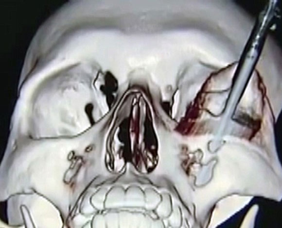 تظهر صور أشعة سينية مرعبة رجل طعن بسكين في العين