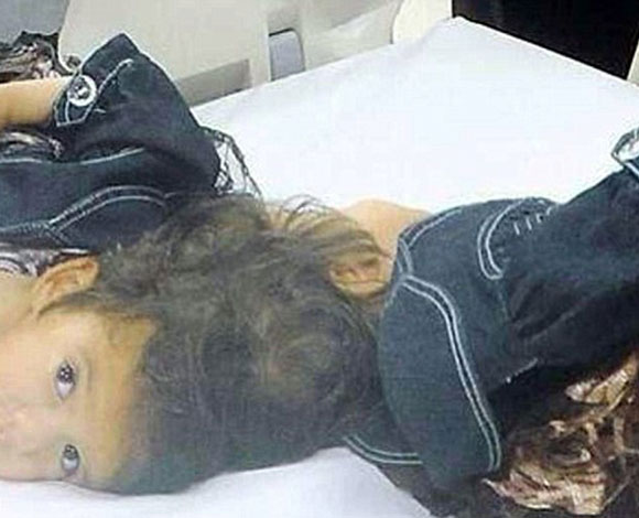 إجراء عملية فصل للشقيقتين السوريتين تقي ويقين الأخضر