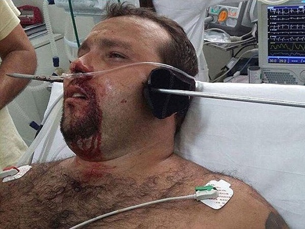 ذهب لاصطياد الأسماك .. فعاد بسهم في رأسه