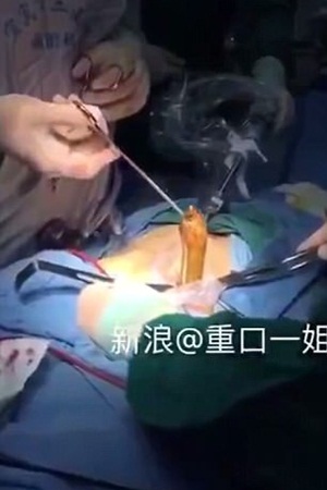 فيديو غريب .. استخراج حنكليس من جسد رجل