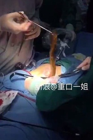 فيديو غريب .. استخراج حنكليس من جسد رجل