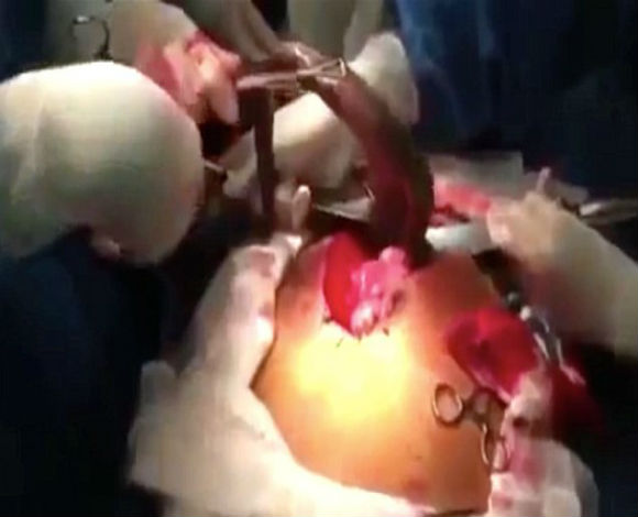 أطباء يستخرجون ثعبان حي من بطن رجل برازيلي