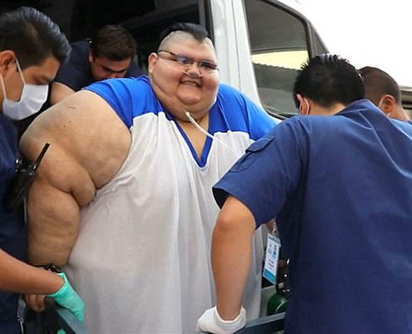 أسمن رجل في العالم يخضع لجراحة بالمعدة بعد أن فقد 385 رطلاً !