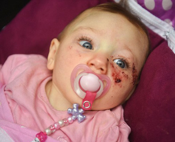 جراحة لإزالة جزء زائد بمؤخرة رأس رضيعة تبقيها على قيد الحياة