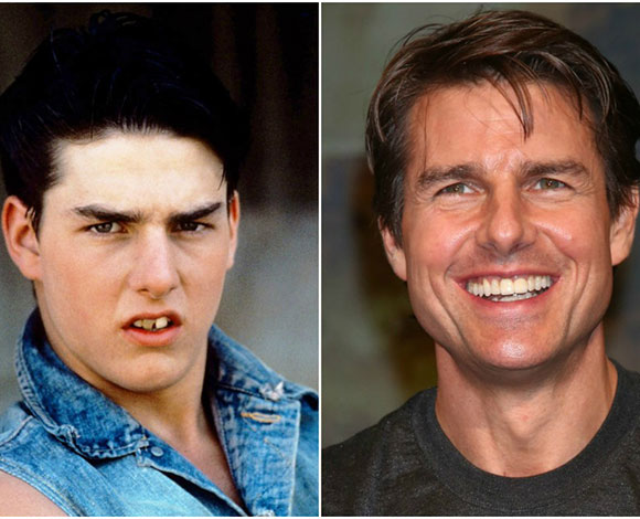 أبزر النجوم الذين خضعوا لعمليات تجميل في أسنانهم