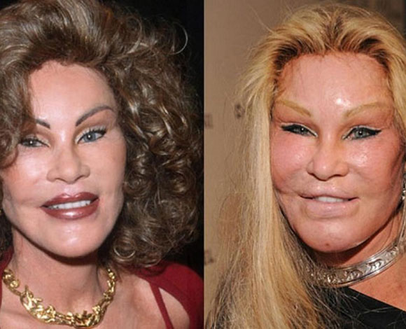 جراحات تجميل فاشلة راح ضحيتها 9 من النجوم والنجمات