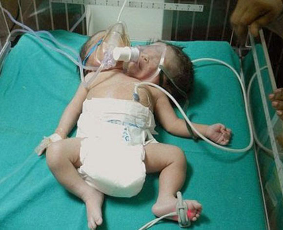 في حادثة نادرة... عربية تضع طفلاً برأسين!