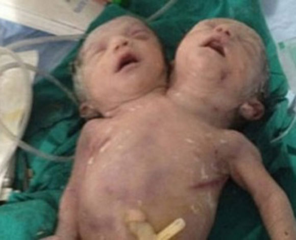 في حادثة نادرة... عربية تضع طفلاً برأسين!