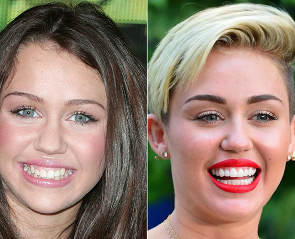 أبزر النجوم الذين خضعوا لعمليات تجميل في أسنانهم