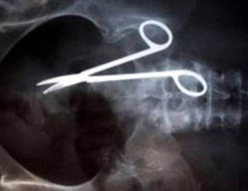 بعد 9 سنوات من العذاب اكتشف مقصاً طبياً في معدته