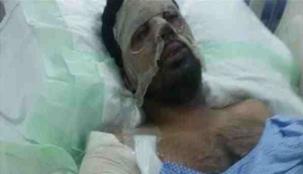بالصور: جندي يروي قصة انفجار لغم بوجهه خلال إنقاذه لزميله