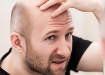 علماء صينيون يخترعون لصاقة تعالج الصلع في أقل من شهر