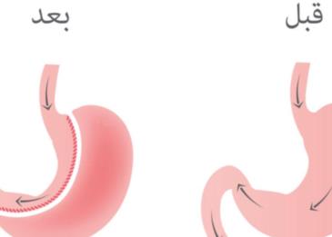 عملية التكميم