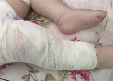 بالصور: عشر إبر في جسد طفلٍ رضيع!